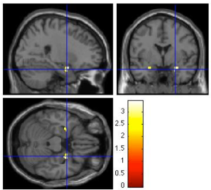 Fig 2: Brain scan showing amygdala – an area with increased functional connectivity to the SMA (supplementary motor area) in FND patients in response to remembering stressful events linked to the onset of symptoms4 