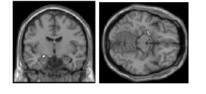 Fig 1: Brain scan showing increased activation in the amygdala of FND patients in response to negative emotional faces1 